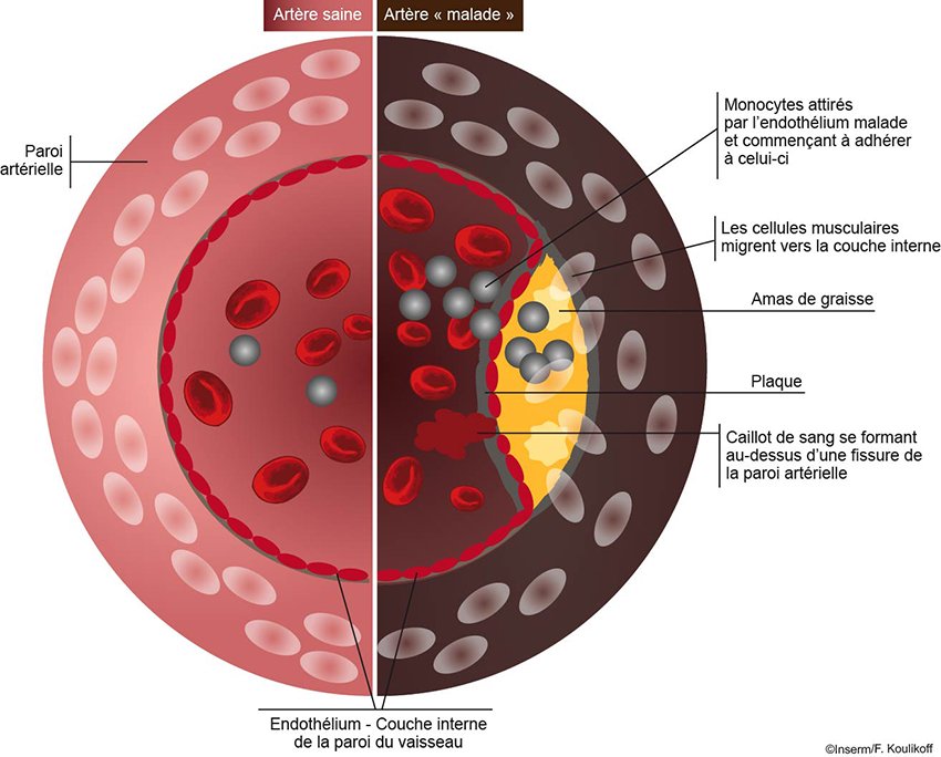 Atherosclerose